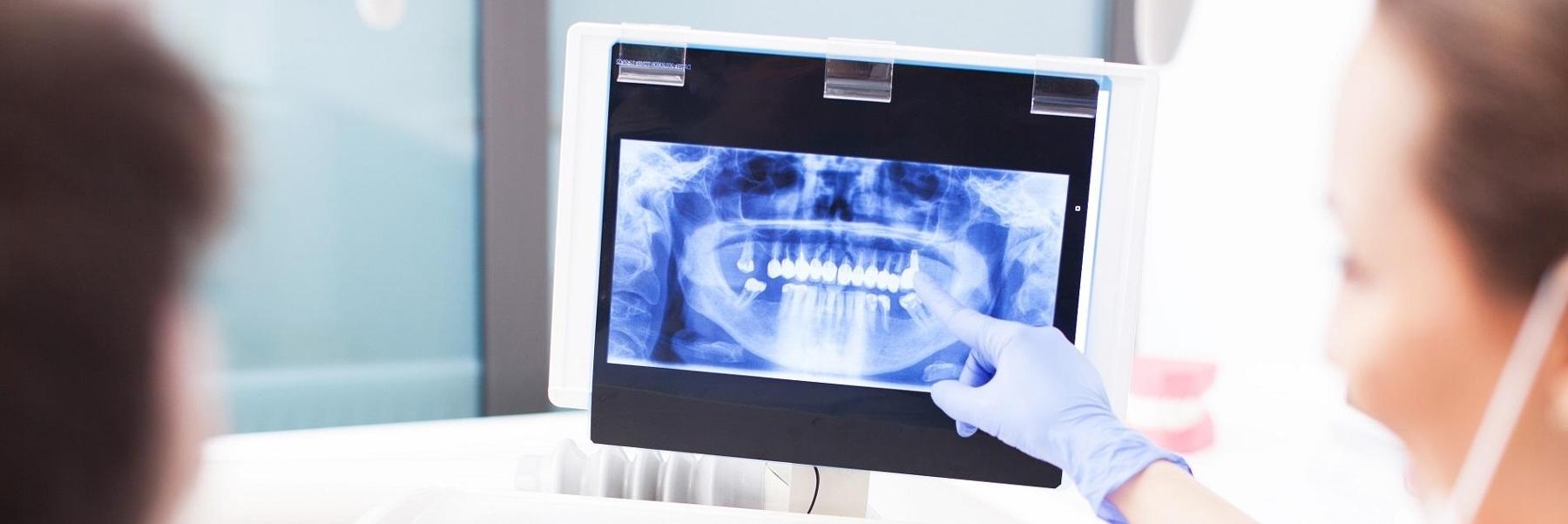 Digital X-Rays | Dentist